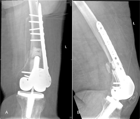 periprosthetic fracture icd 10|icd 10 periprosthetic femur fracture.